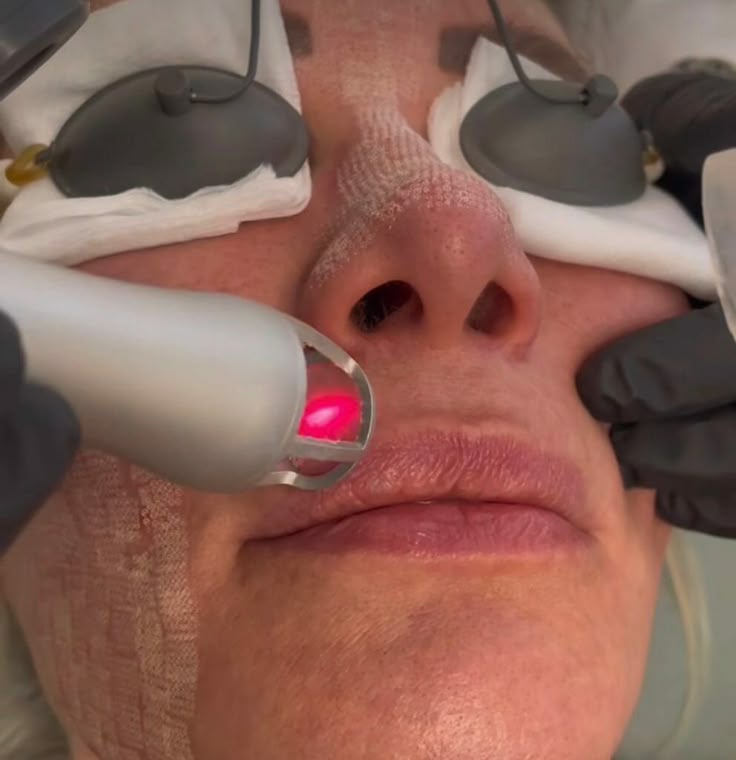 How Subcision and Dermal Fillers Smooth Out Stubborn, Depressed Scars